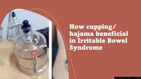 How cupping hajama beneficial in Irritable Bowel Syndrome