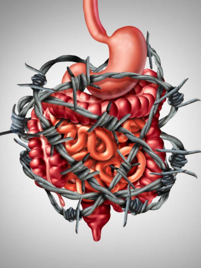 Irritable Bowel Syndrome IBS (1)